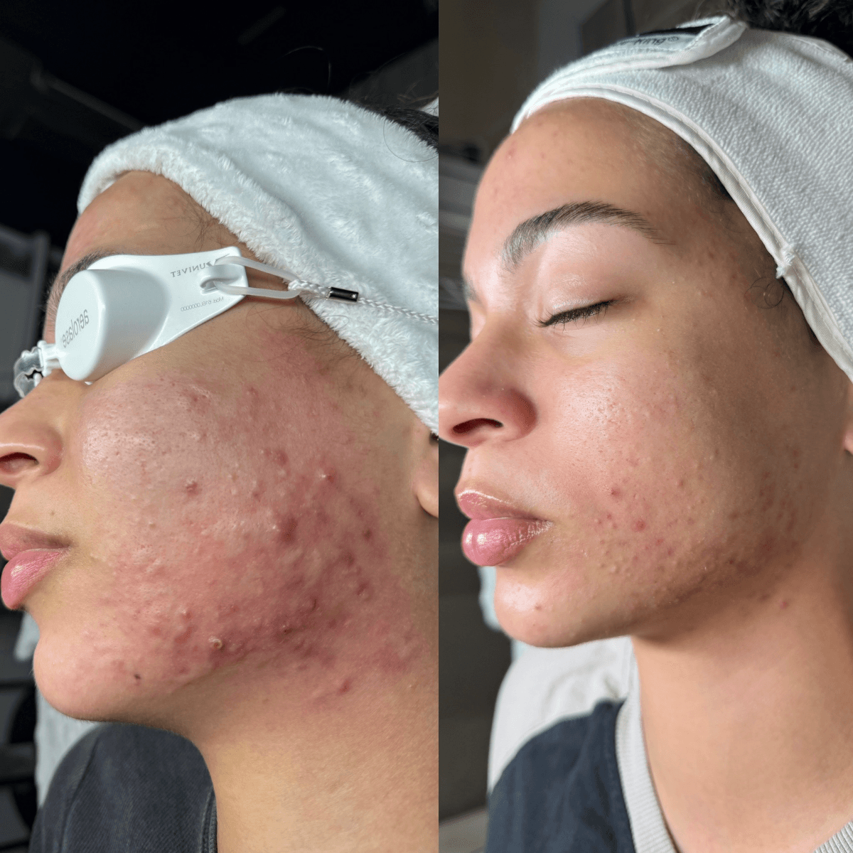 Before and After