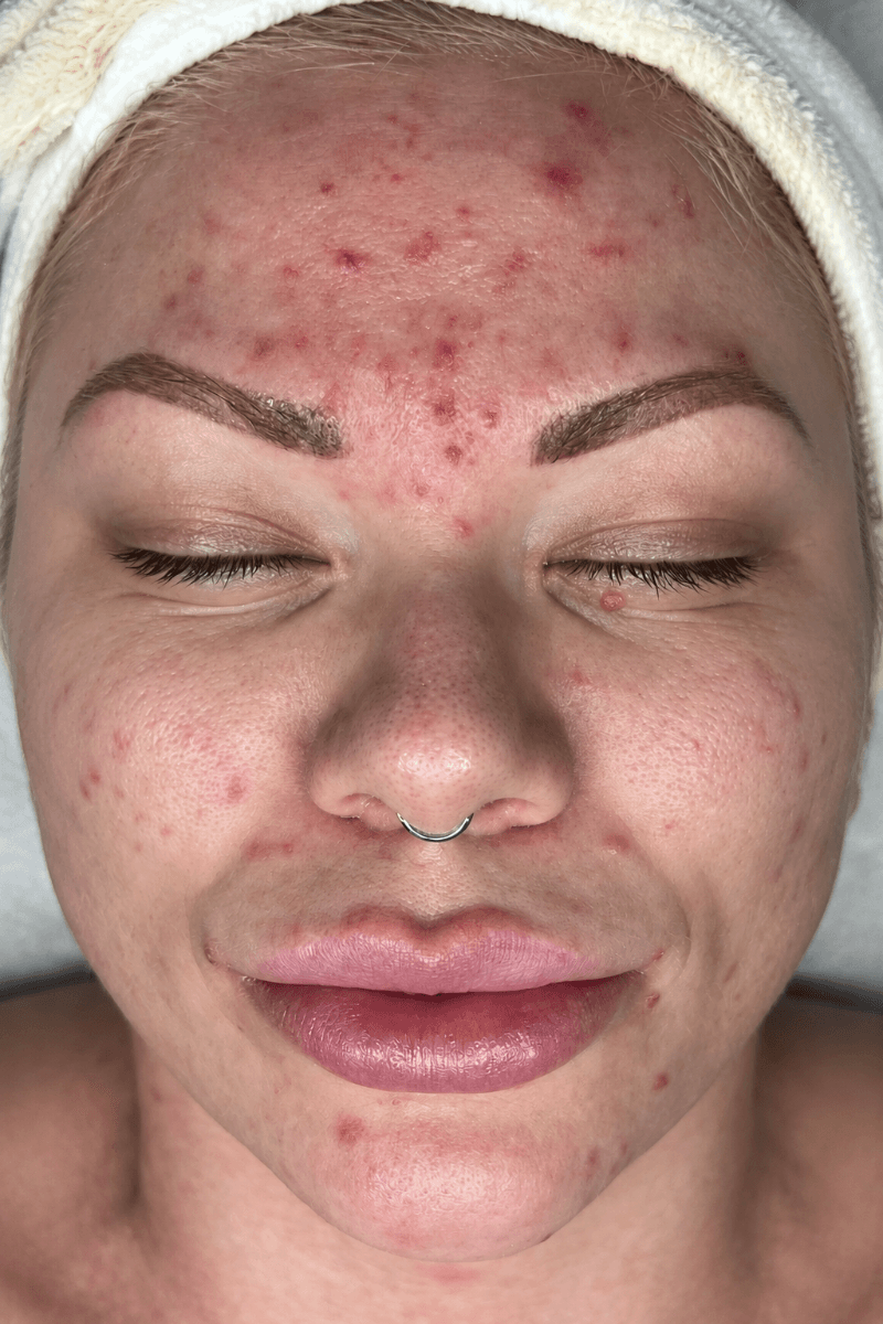Before treatment