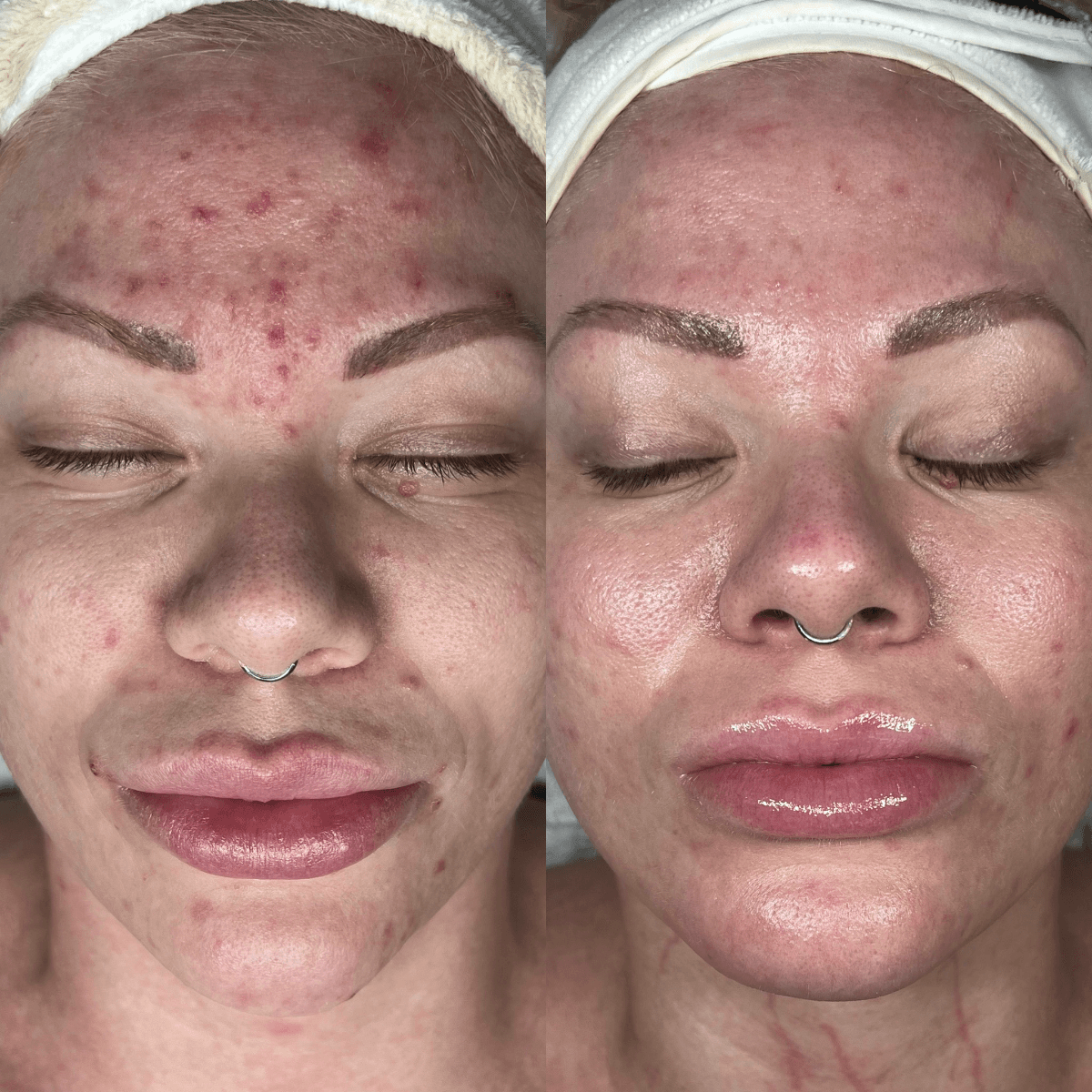 Before and After